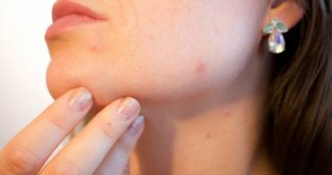 Come curare l’acne in età adulta